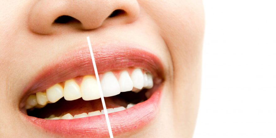 Teeth Whitening Mumbai