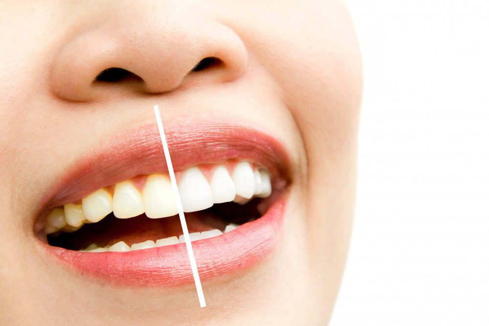 How to Whiten Your Teeth Safely Dentist-Approved Tips
