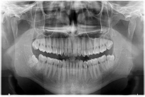 Dental opg xray (1)