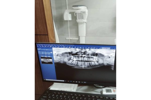 OPG Dental X-ray